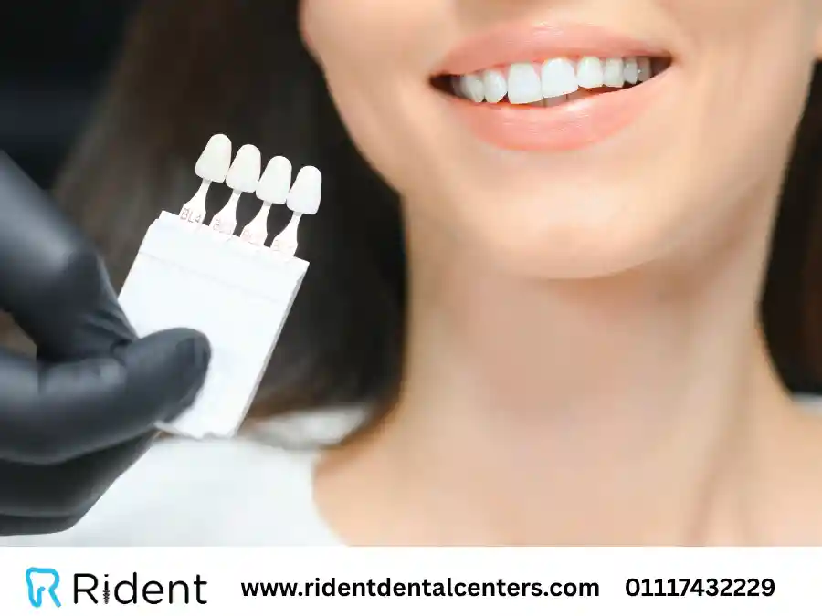 دليلك لمعرفة طرق ودرجات تبييض الاسنان